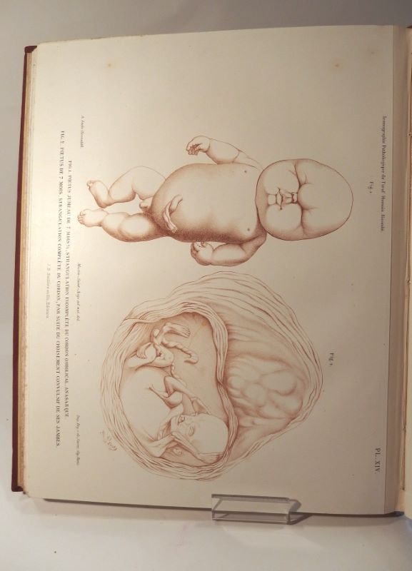 Couverture du livre Estimation du livre « iconographie pathologique de l’oeuf humain fécondé. En rapport avec l’étiologie de l’avortement »